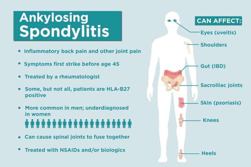 Ankylosing Spondylitis Menopause: Key Facts for Women