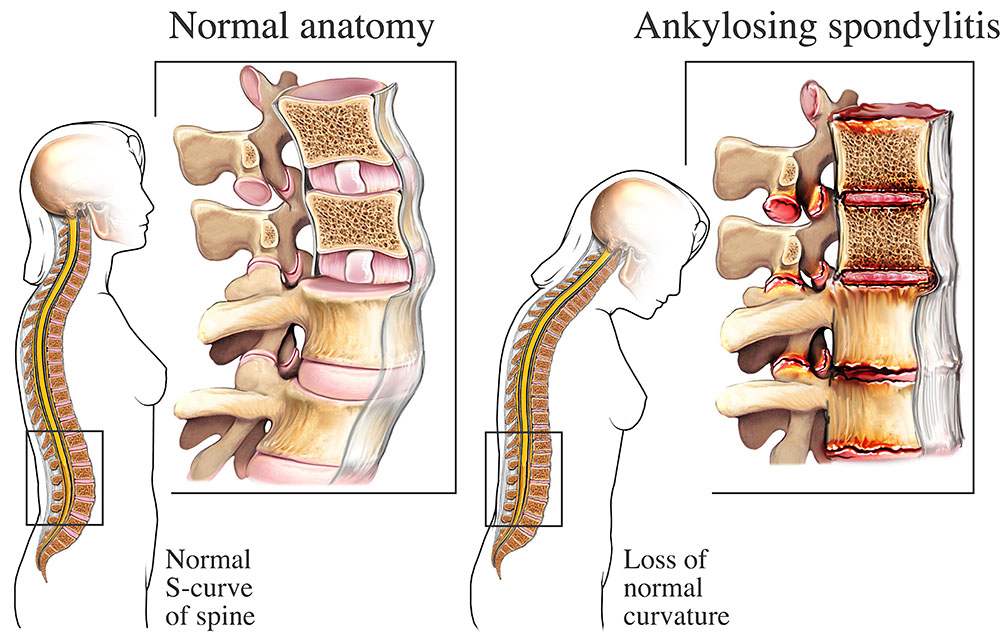 Ankylosing Spondylitis Prognosis: What to Expect
