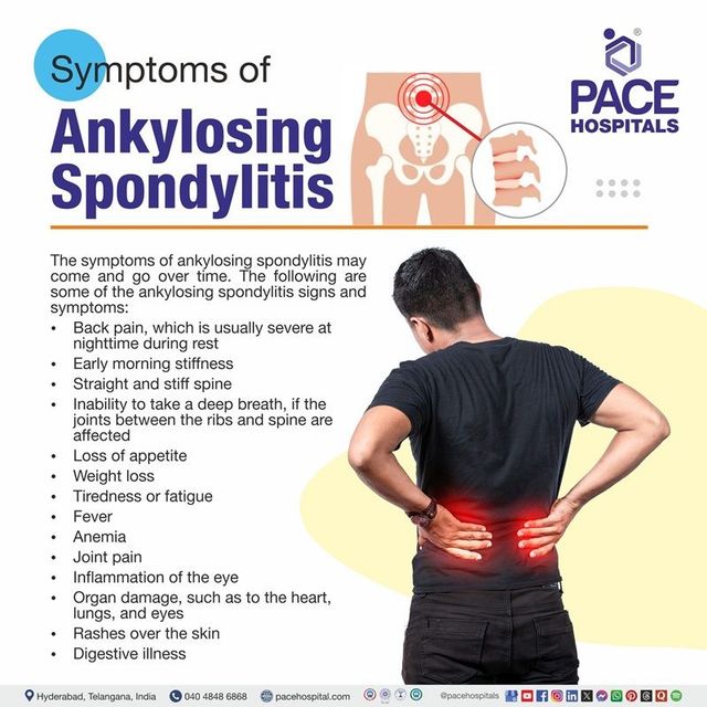 Ankylosing Spondylitis Symptoms in Females: Key Signs