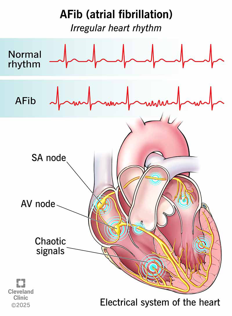Atrial Fibrillation Symptoms: What to Watch For