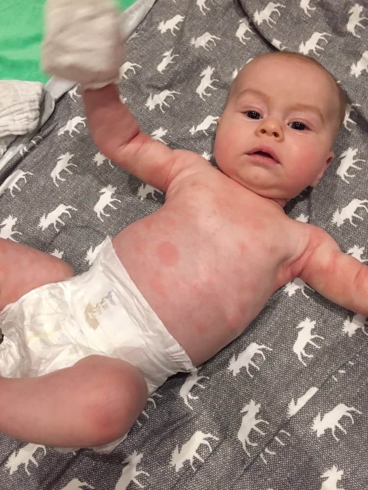 Understanding Baby Allergy Symptoms: A Parent’s Guide