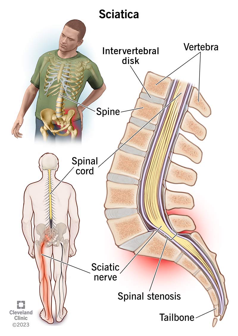 Back Nerve Pinched: Fast Relief, Causes & What to Do