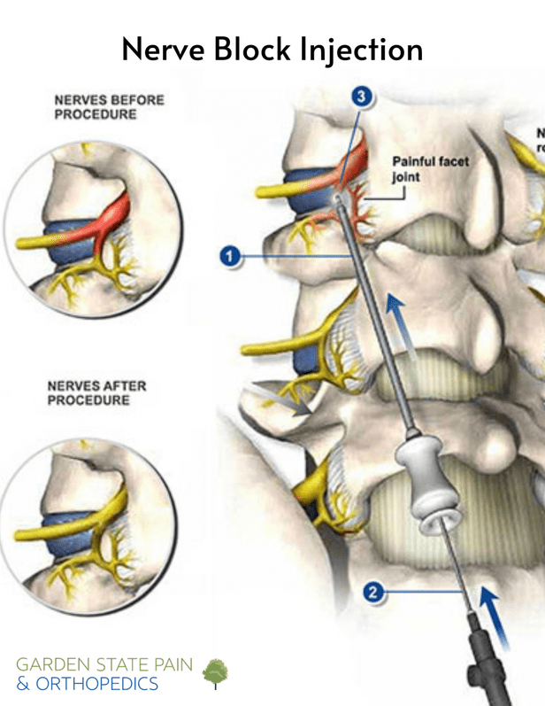 Back Pain Treatment Injection: What You Need to Know
