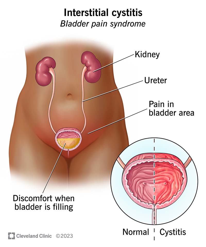 Bladder Pain Symptoms: Meaning & Quick Relief