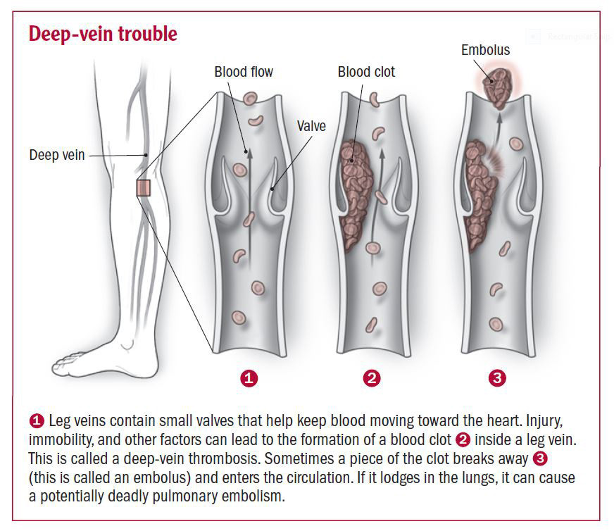 Blood Clot Test: Quick Guide to What It Means for You