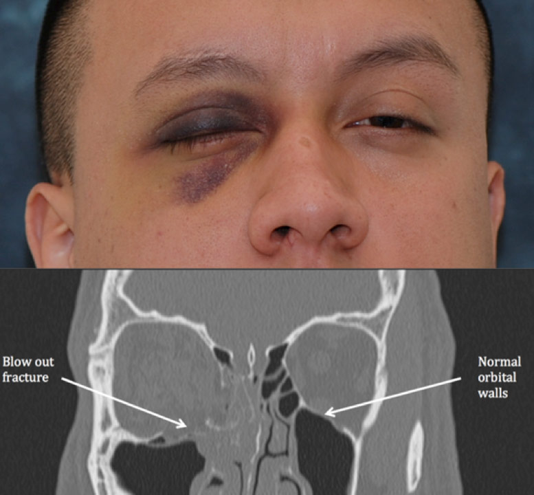 Blowout Fracture: Symptoms, Causes, and Treatment Guide
