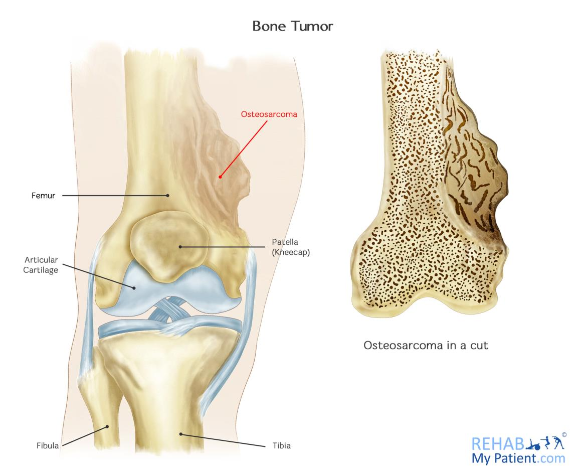 Bone Tumor Knee: Types, Signs, Treatment & Essential Help Guide