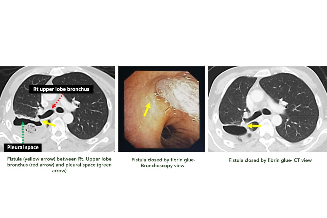 Bronchopleural Fistula: What It Is, Risks & Treatment