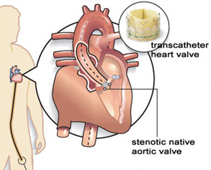 Can a Heart Valve Be Replaced Without Open‑Heart Surgery?