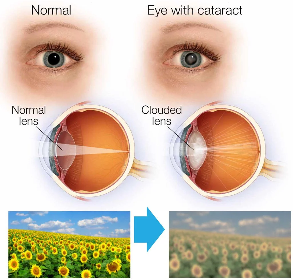 Cataract Blurry Vision: What It Looks Like & Fixes