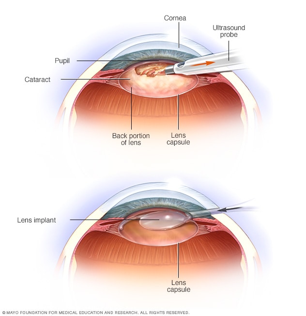 Cataract Research Treatments: New Options and Facts