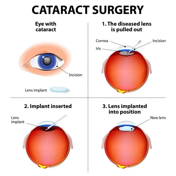 Cataract Surgery Symptoms: What to Expect and Tips