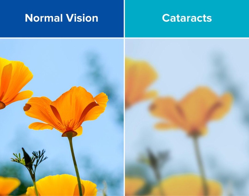 Cataract Vision Changes: Symptoms, Causes & Treatment