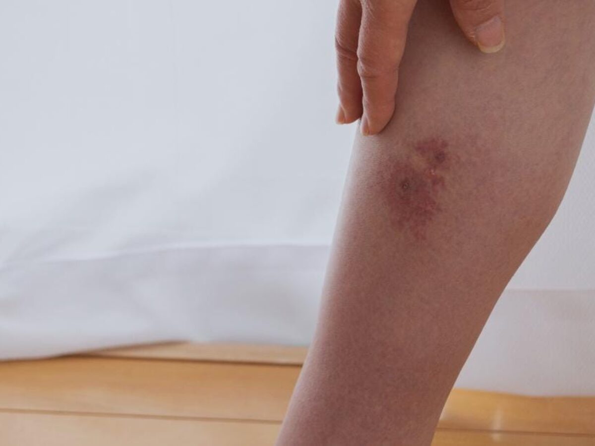 Cellulitis Aftercare: Essential Steps for Faster Healing