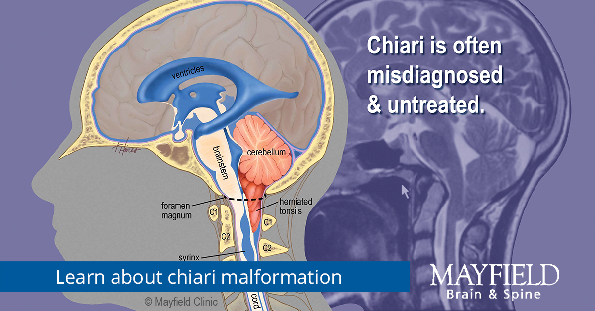 Chiari Malformation Gut: What You Need to Know