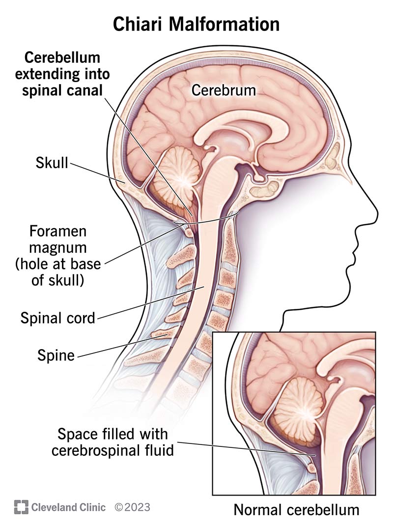 Chiari Malformation Symptoms: What You Need to Know