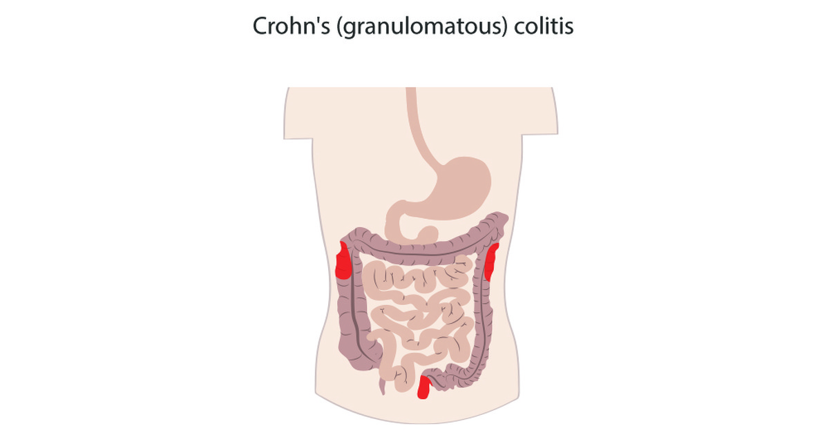 Crohn's Granuloma Causes: What Triggers Inflammation?
