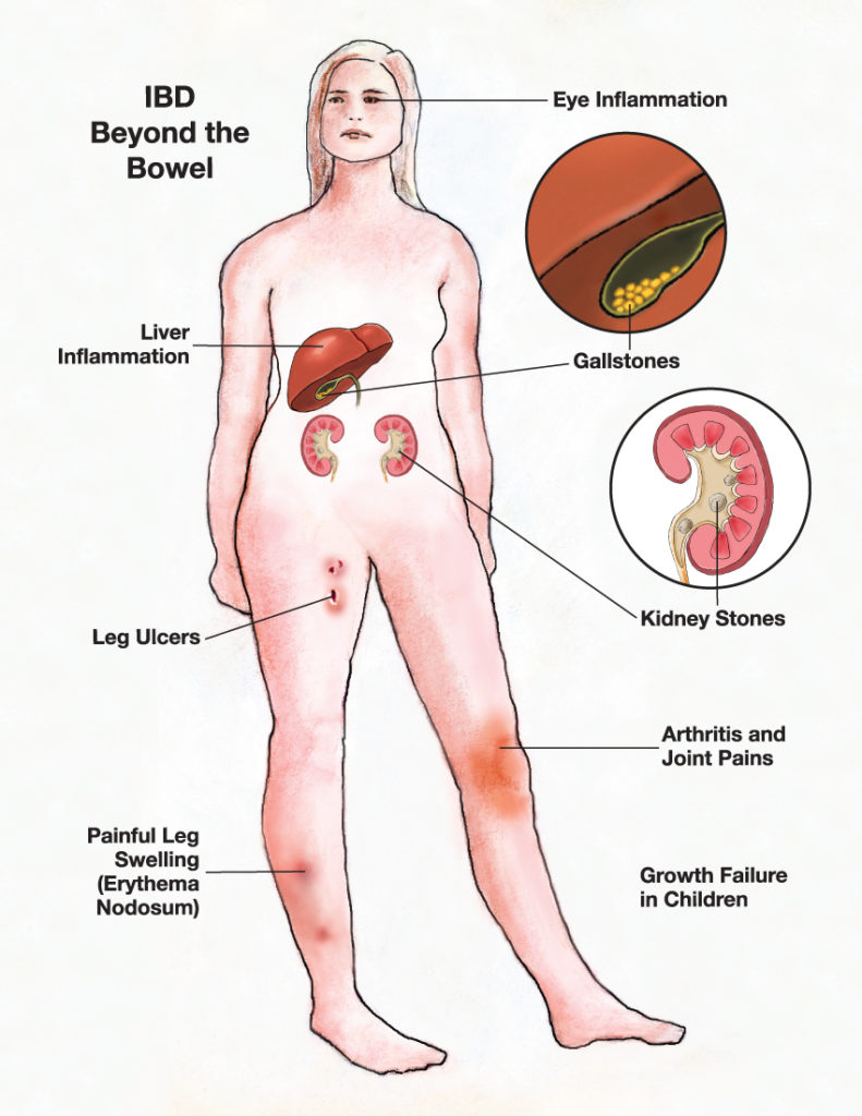 Crohn’s Joint Pain: Causes, Symptoms & Treatment