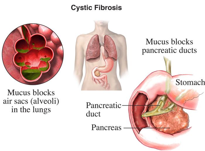 Cystic Fibrosis Digestion: What You Need to Know