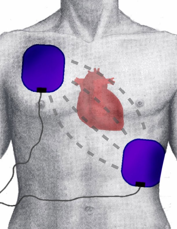 Understanding Defibrillator Function: How It Saves Lives