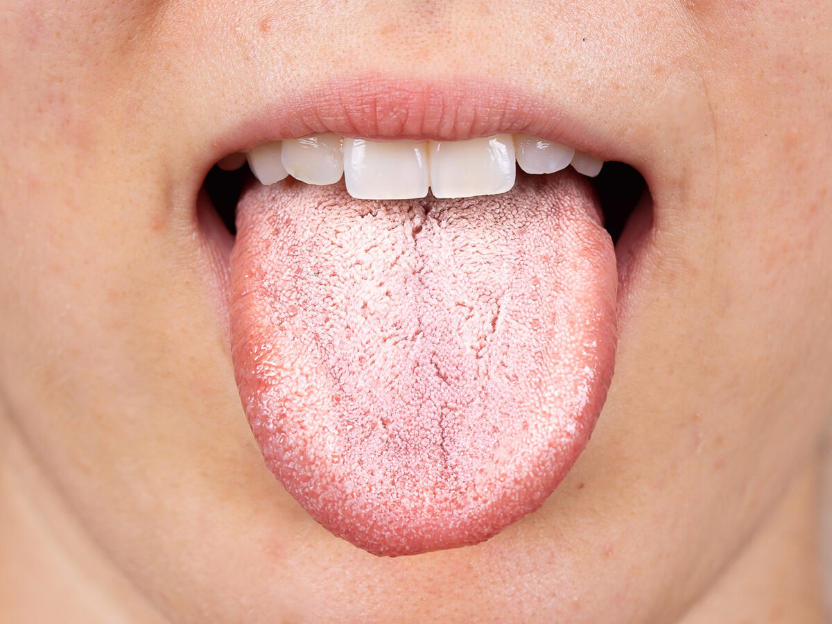 Dental Health Psoriasis: Essential Tips You Should Know