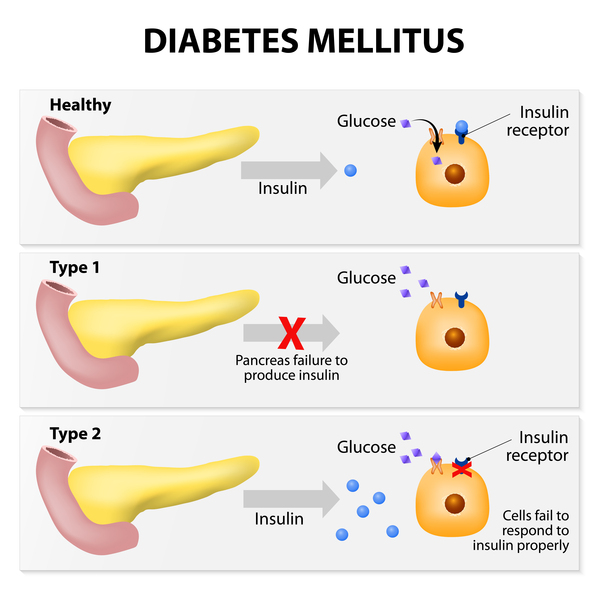 Diabetes Hereditary Factors: What You Need to Know