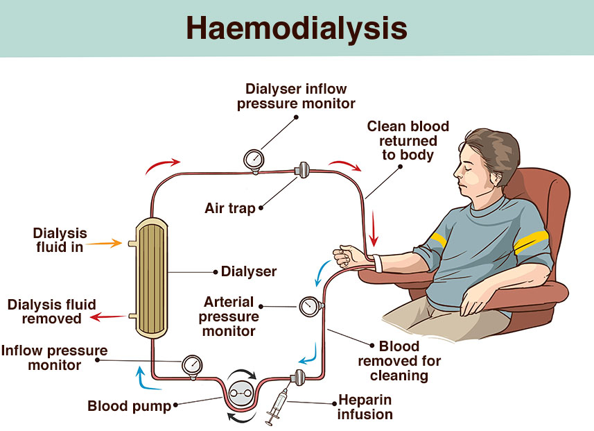 Dialysis for Renal Failure: Choices, Risks & Hope