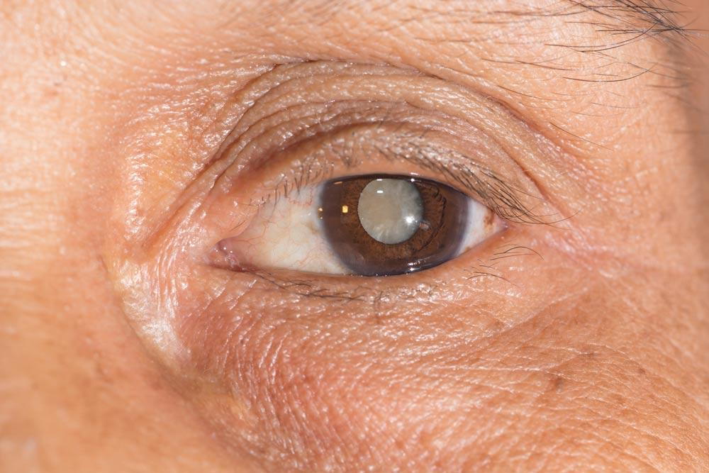 Early Cataract Signs: Spot Them Fast, Keep Vision Sharp