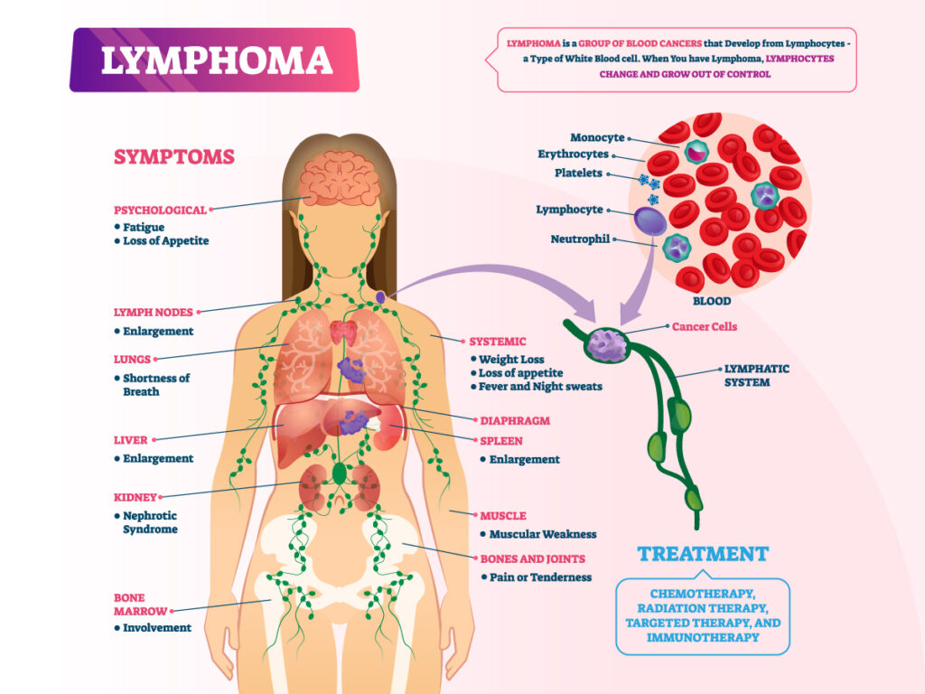 Female Lymphoma Signs – Spotting Early Warning Signals