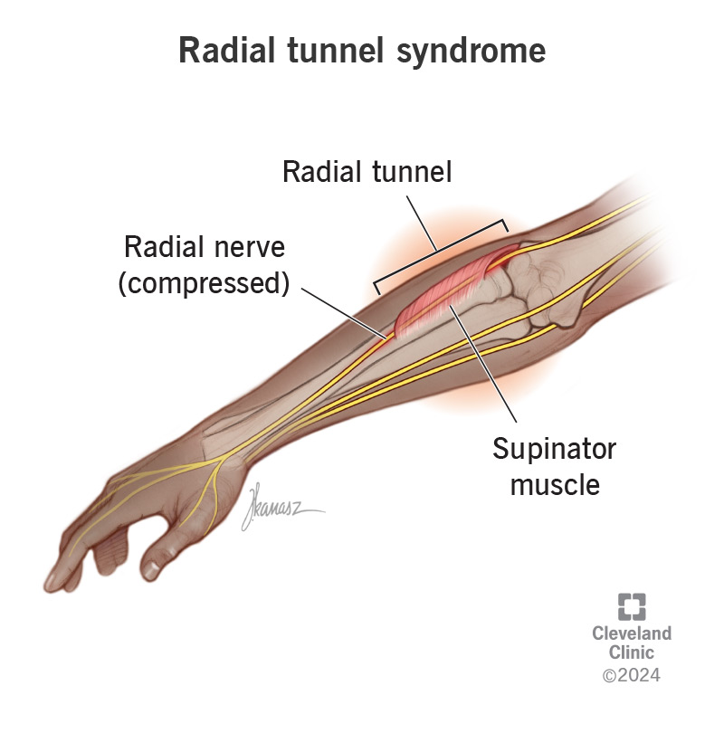Forearm Pain Relief: Quick Answers & Proven Treatments