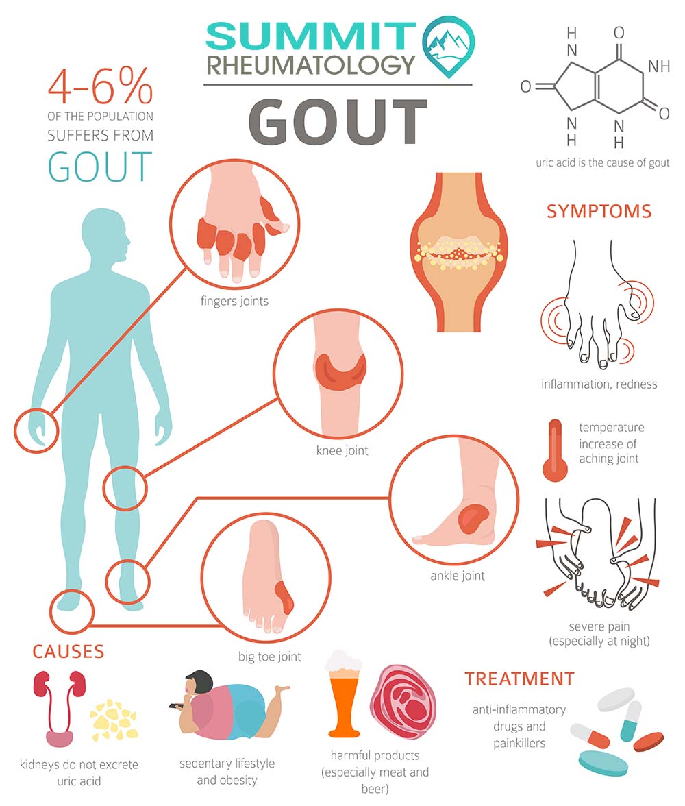 Gout Causes – What Really Triggers a Gout Attack?