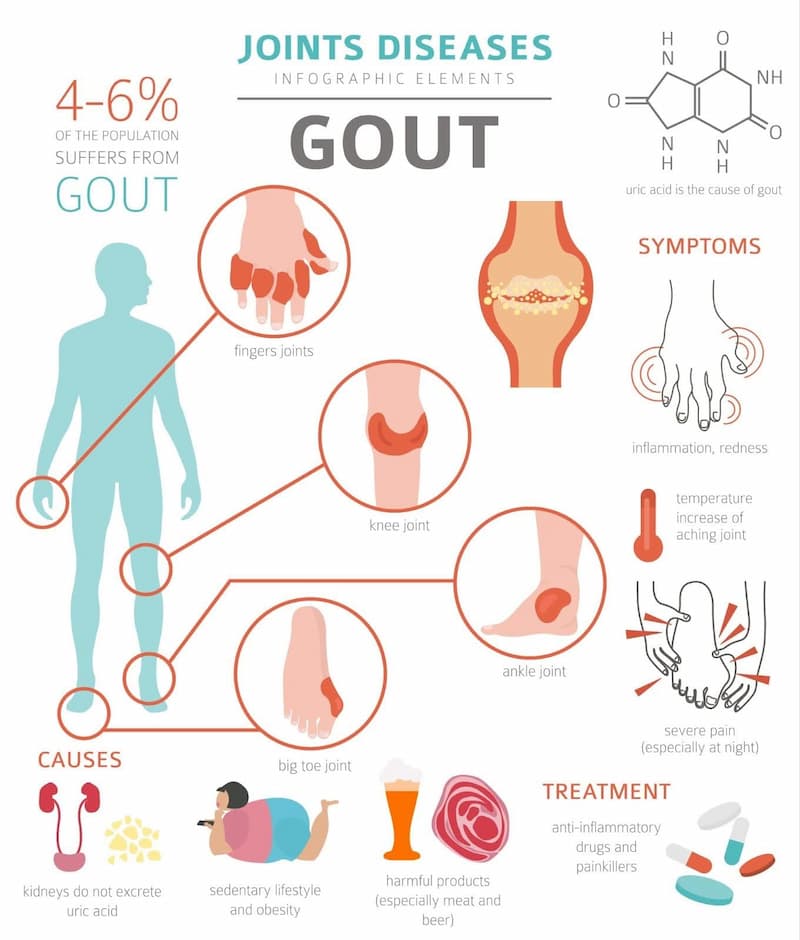 Effective Gout Treatment: Fast Relief & Lasting Care