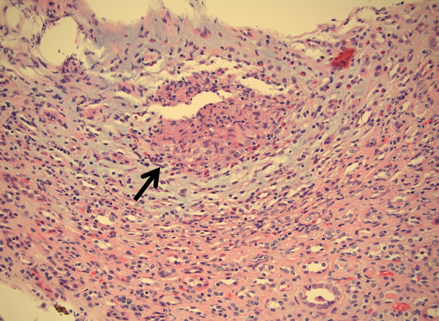 Granulomas in Crohn’s: What They Mean for You