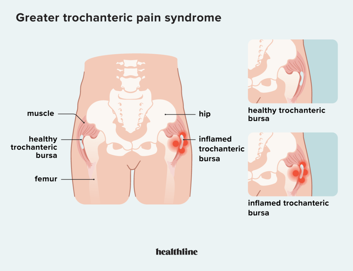 Greater Trochanter Pain Relief: Quick Answers and Proven Strategies