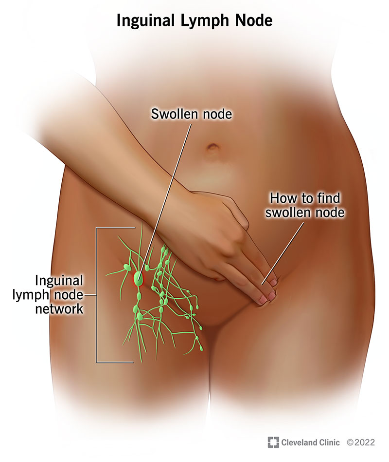 Groin Swelling: Causes, Symptoms & When to Seek Help