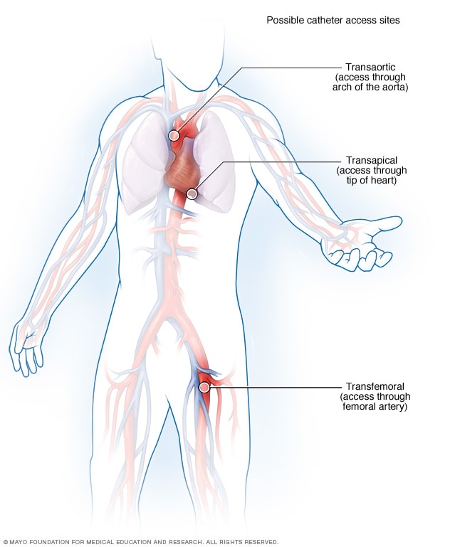 Heart valve replacement through the groin recovery time