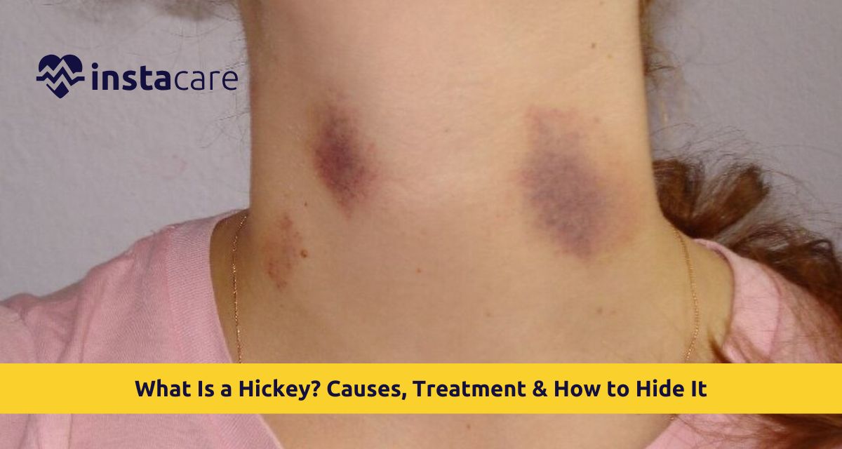 Hickey vs Rash: Spot the Difference and Stay Safe