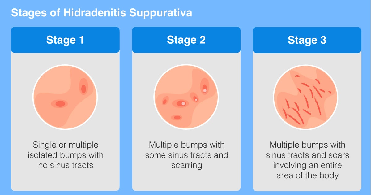 Hidradenitis Stage 1 Causes: Early Signs Explained