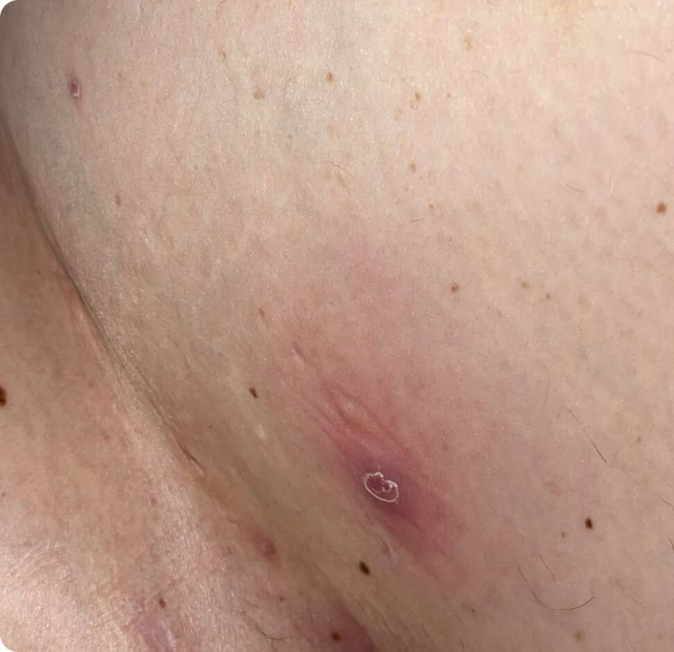 Hidradenitis Stage 1 Symptoms – What to Spot Right Away