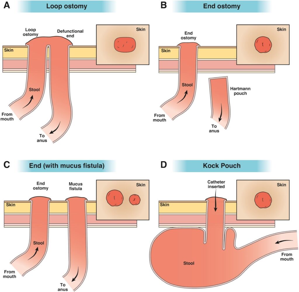 High Output Ileostomy: Risks, Relief & Simple Tips