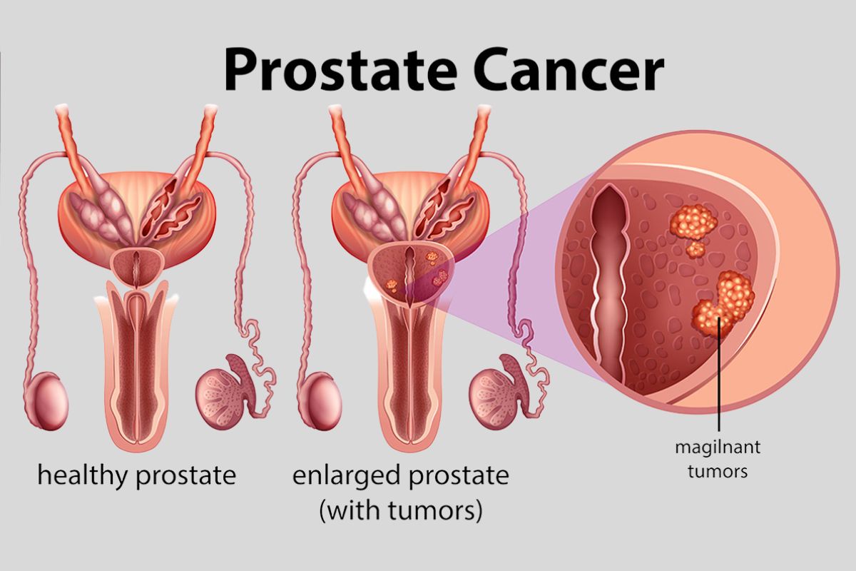 How Long Can a Man Stay on Hormone Therapy for Prostate Cancer?