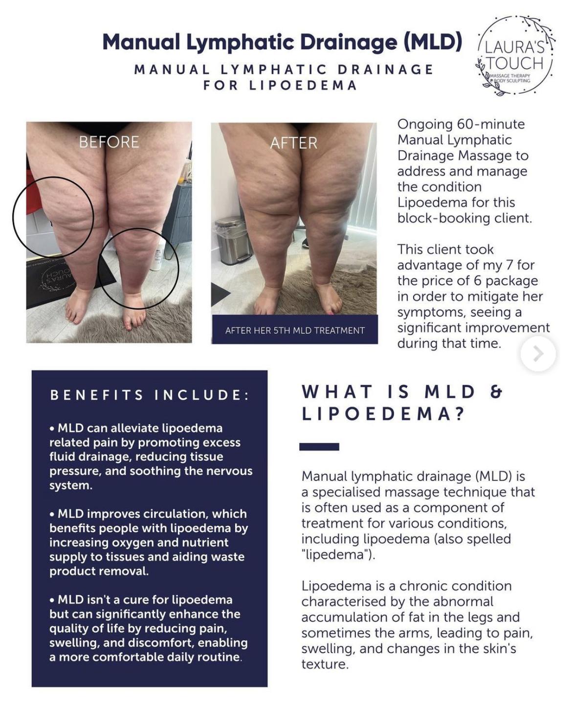 How to Drain Edema Fluid – Fast, Safe & Effective