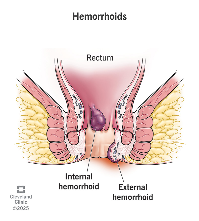 Itchy Hemorrhoids: Causes, Relief & Night‑time Tips