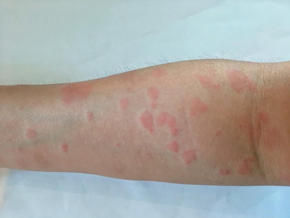 Itchy Rash Lupus: Signs, Causes & How to Soothe Tonight