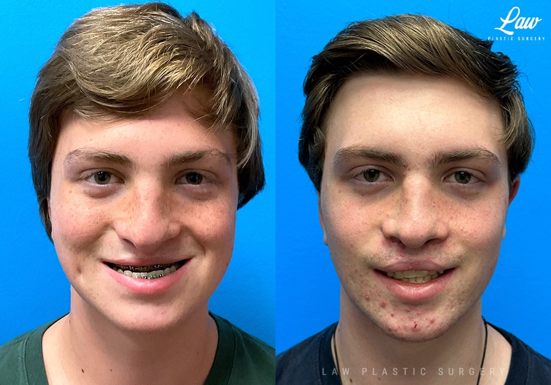 Jaw Surgery: What to Expect, Risks & Recovery Guide