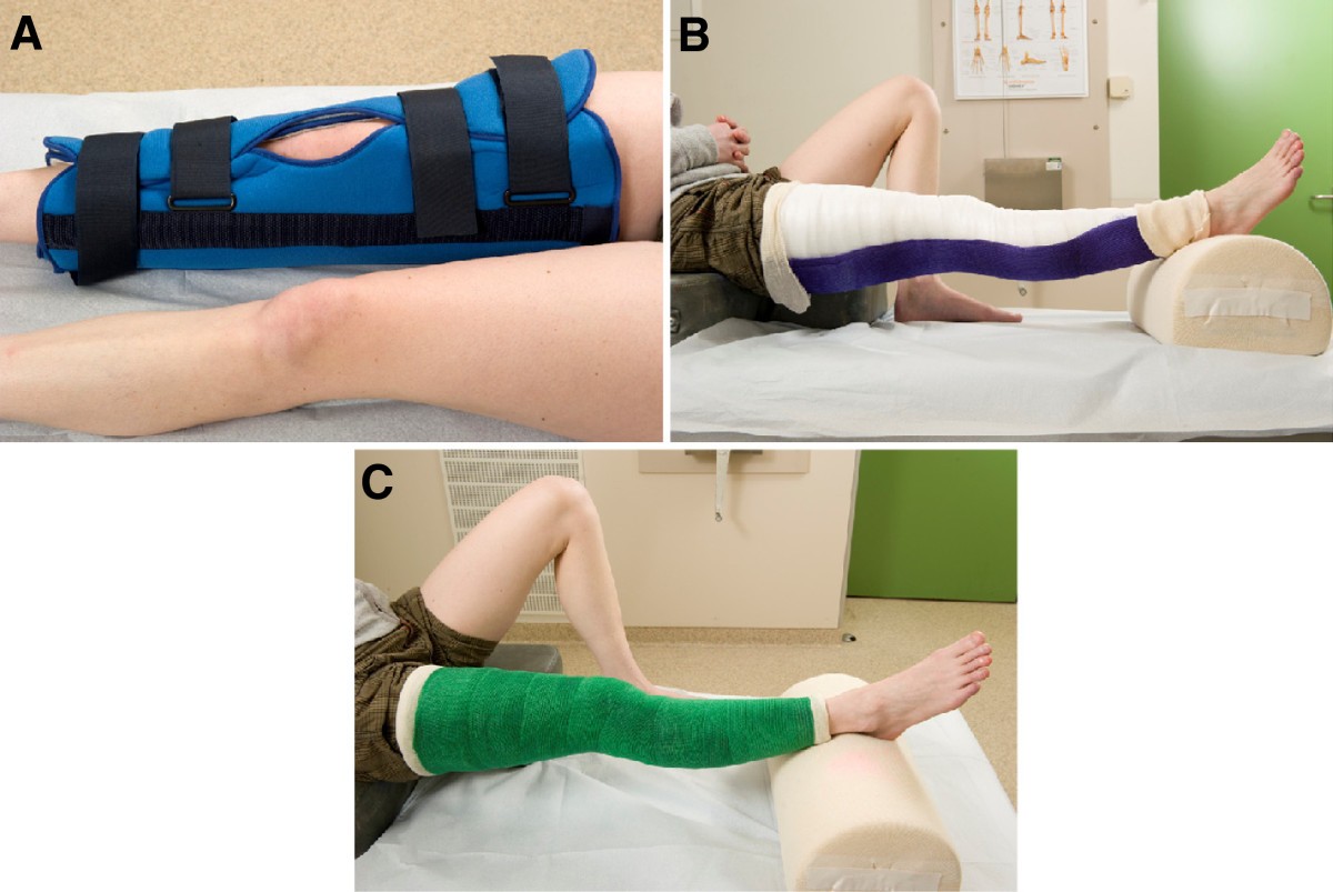 Knee Fracture Cast: How It Works, Recovery Timeline