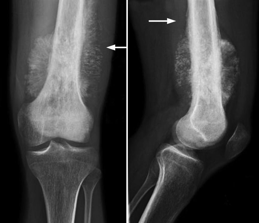 Knee Osteosarcoma – Signs, Diagnosis, Treatment & Outlook