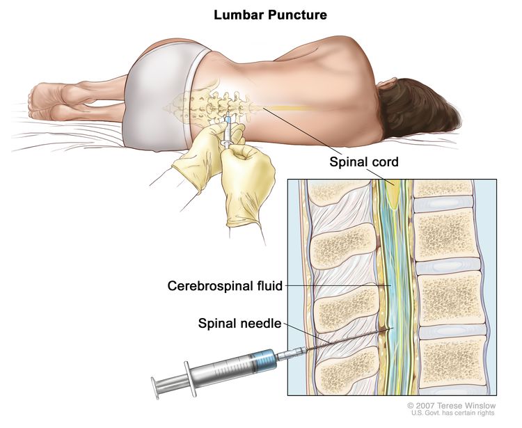 Leukemia in Spinal Fluid Survival Rate Explained