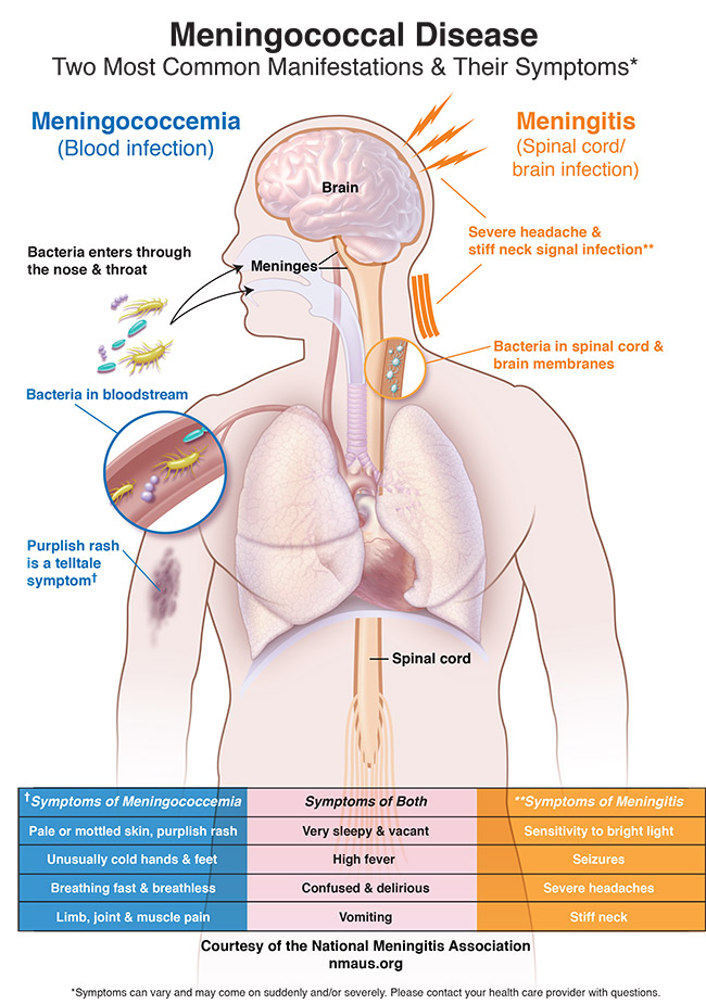 Leukemic Meningitis Symptoms: What You Need to Know