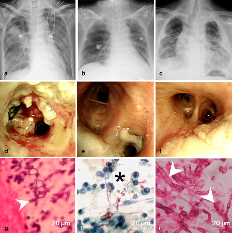 Lung Fungus Infection: What You Need to Know Today